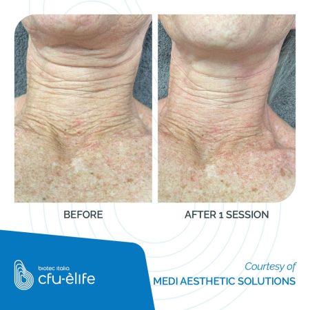 CFU-ELIFE_Before-After_39