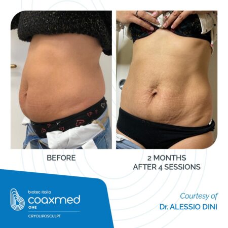 COAXMED-ONE_Cryoliposculpt_Before-After_01