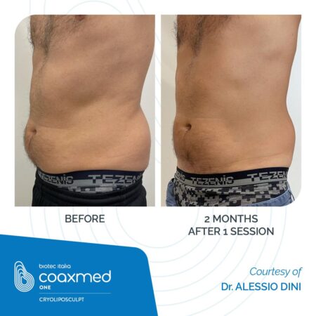 COAXMED-ONE_Cryoliposculpt_Before-After_02