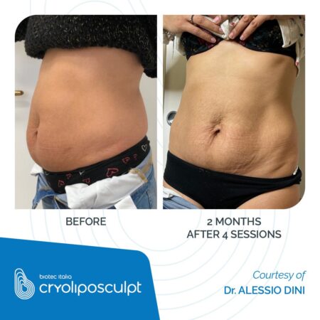 CRYOLIPOSCULPT_Before-After_01