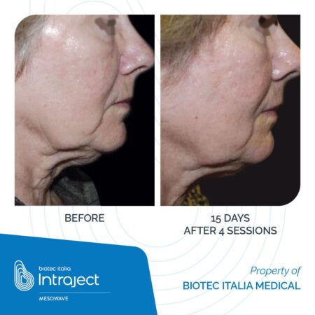 INTRAJECT_Mesowave_Before-After_01 (1)
