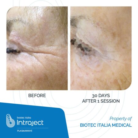 INTRAJECT_Plasmawave_Before-After_01