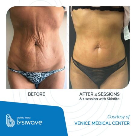LYSIWAVE_Before-After_58