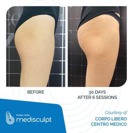 MEDISCULPT_Before-After_01 (1)