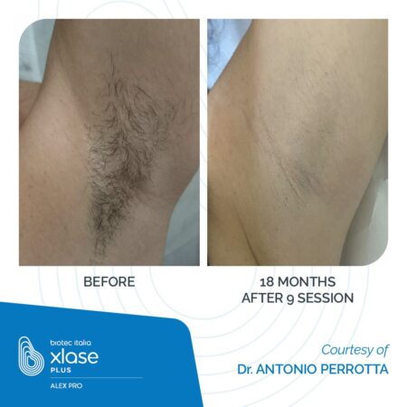 XLASE-PLUS_AlexPro_Before-After_03