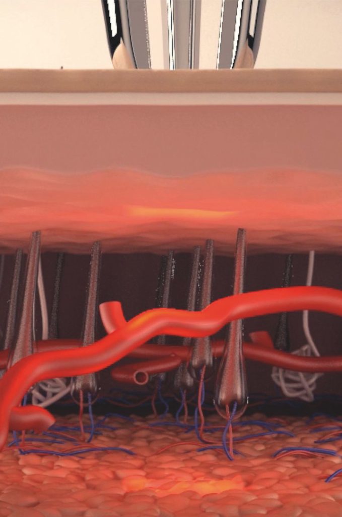 xlase-plus-biotec-italia-slp-nd-yag